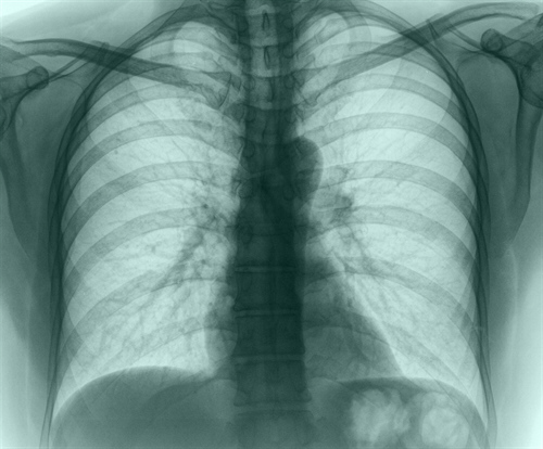 Chronic Obstructive Pulmonary Disease (COPD) Health Plan