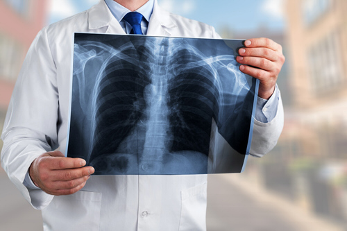 Pulmonary Tuberculosis Health Plan