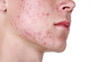 What is Acne and What Causes It? | www.serrapeptase.info