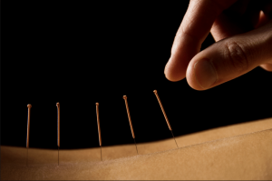 what are the benefits of acupunture