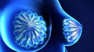 What causes Fibrocystic Breast Disease
